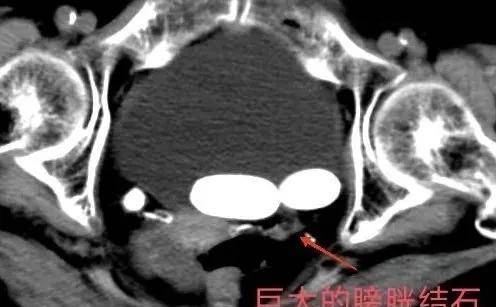 90歲老人家，依然可以行尿路結石的微創手術