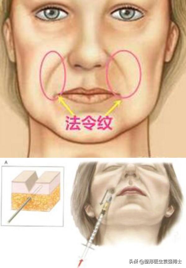 整形醫生說：面部除皺這3種方法還不錯