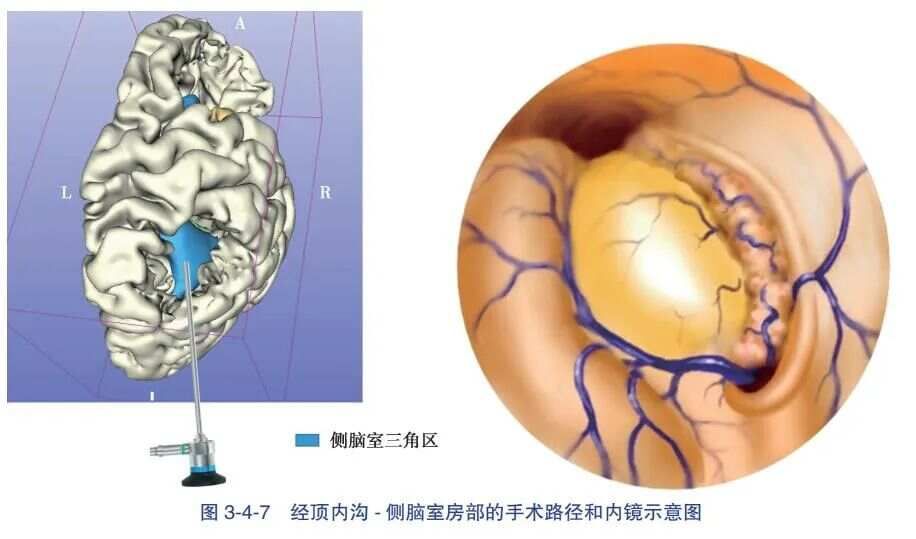 經頂内溝- 側腦室三角區入路血腫清除術-人衛書摘