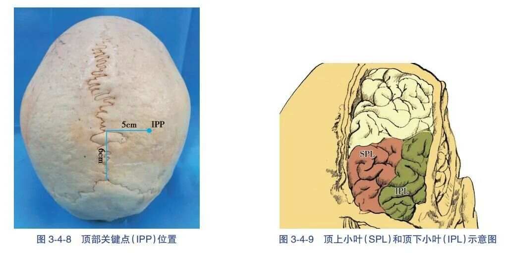 經頂内溝- 側腦室三角區入路血腫清除術-人衛書摘