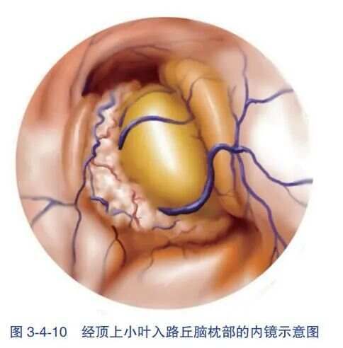 經頂内溝- 側腦室三角區入路血腫清除術-人衛書摘