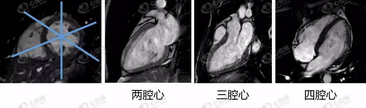 微课堂CMR基础篇：基本扫描序列