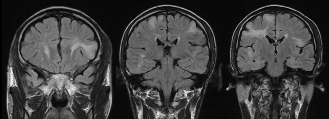 推薦收藏 | 結節性硬化的臨床、影像學表現