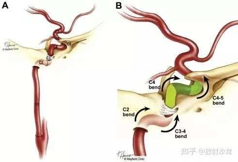 最全整理：脑动脉解剖、分段及供血区图谱