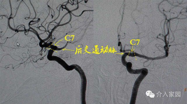 最全整理：脑动脉解剖、分段及供血区图谱