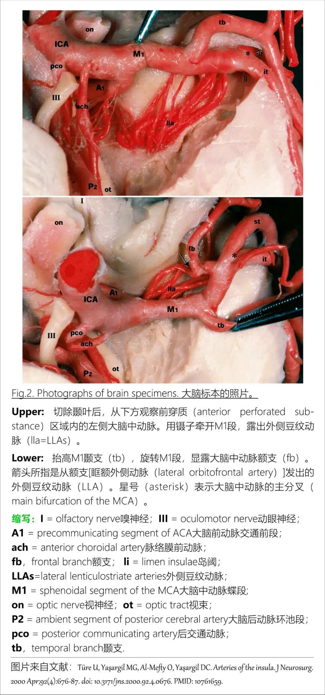 最全整理：脑动脉解剖、分段及供血区图谱