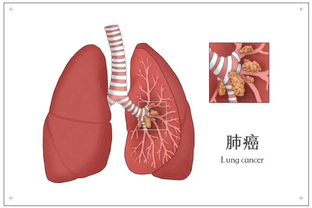 中醫張勝兵醫案—肺癌術後又複發，瘦得隻有60多斤，中藥治療2月後...